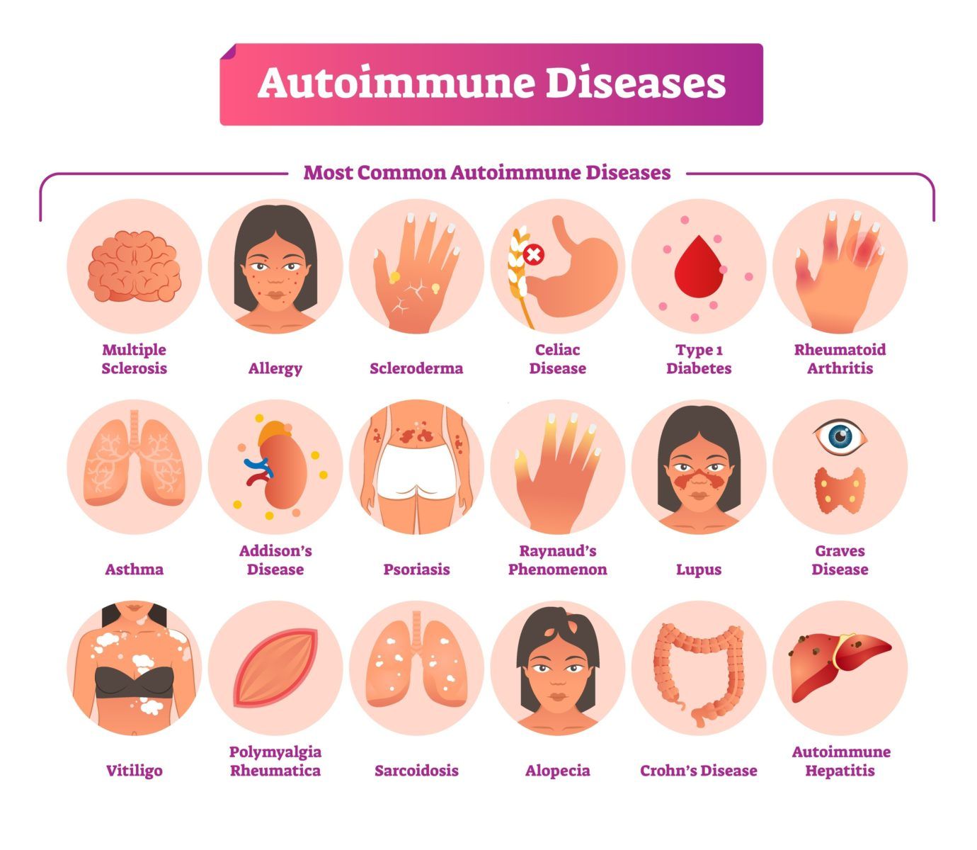 Exploring Autoimmune Diseases: Causes, Symptoms, and Treatment Options post thumbnail image
